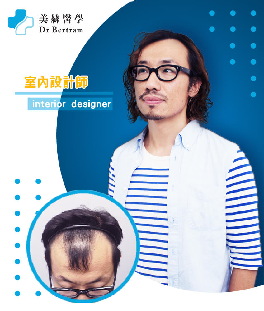 Hair restoration clinical result