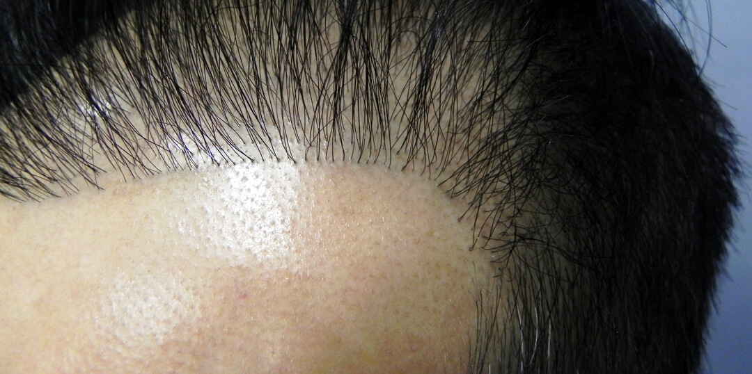 Irreversible thinning in the donor area