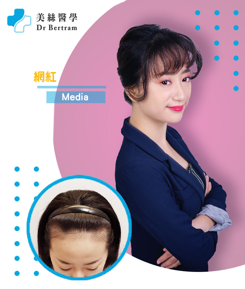 Hair restoration result at 12 months